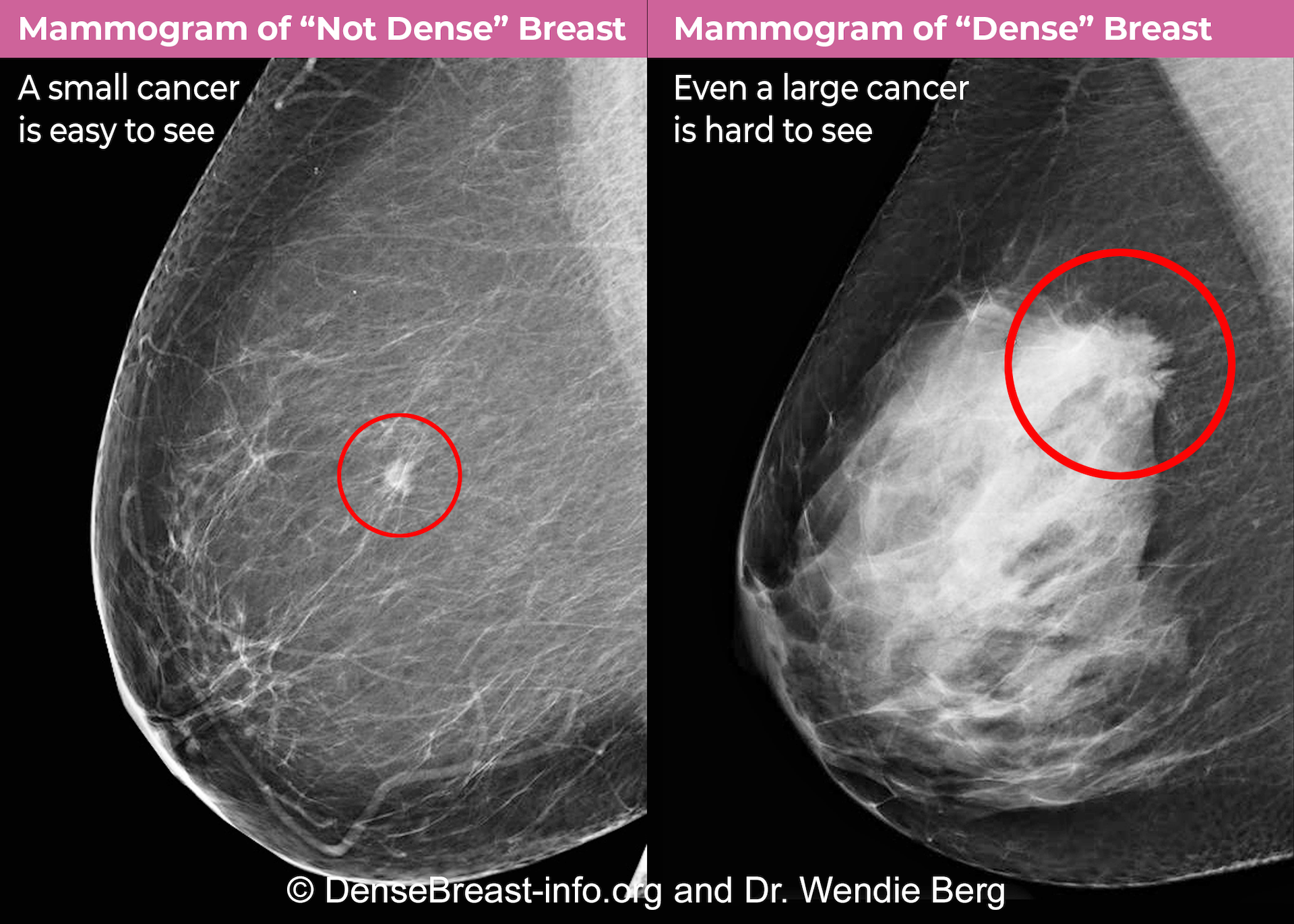 Mammography comparison of cancer easily seen in a a fatty ('not dense') breast on the left and hard to see in a 'dense' breast on the right.