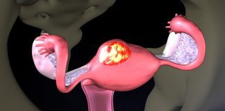 Medical Therapy for Uterine Fibroids