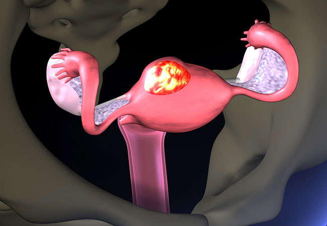 Medical Therapy for Uterine Fibroids