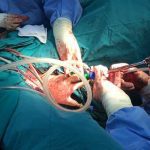 Laparoscopic vs. Robotic Surgery for Endometriosis