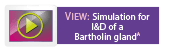 Simulation for I&D if a Bartholin Gland 