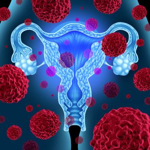 Vaginal Microbiome and Gynecological Cancer