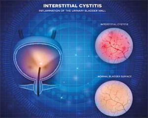 interstitial cystitis algorithm simplify diagnosis chronic urinary symptom