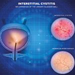 interstitial cystitis algorithm simplify diagnosis chronic urinary symptoms