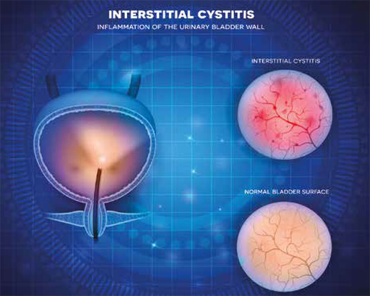 interstitial cystitis algorithm simplify diagnosis chronic urinary symptoms