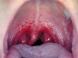 Diseases Passed By Oral Sex