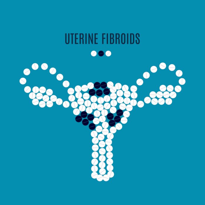 What are uterine fibroids