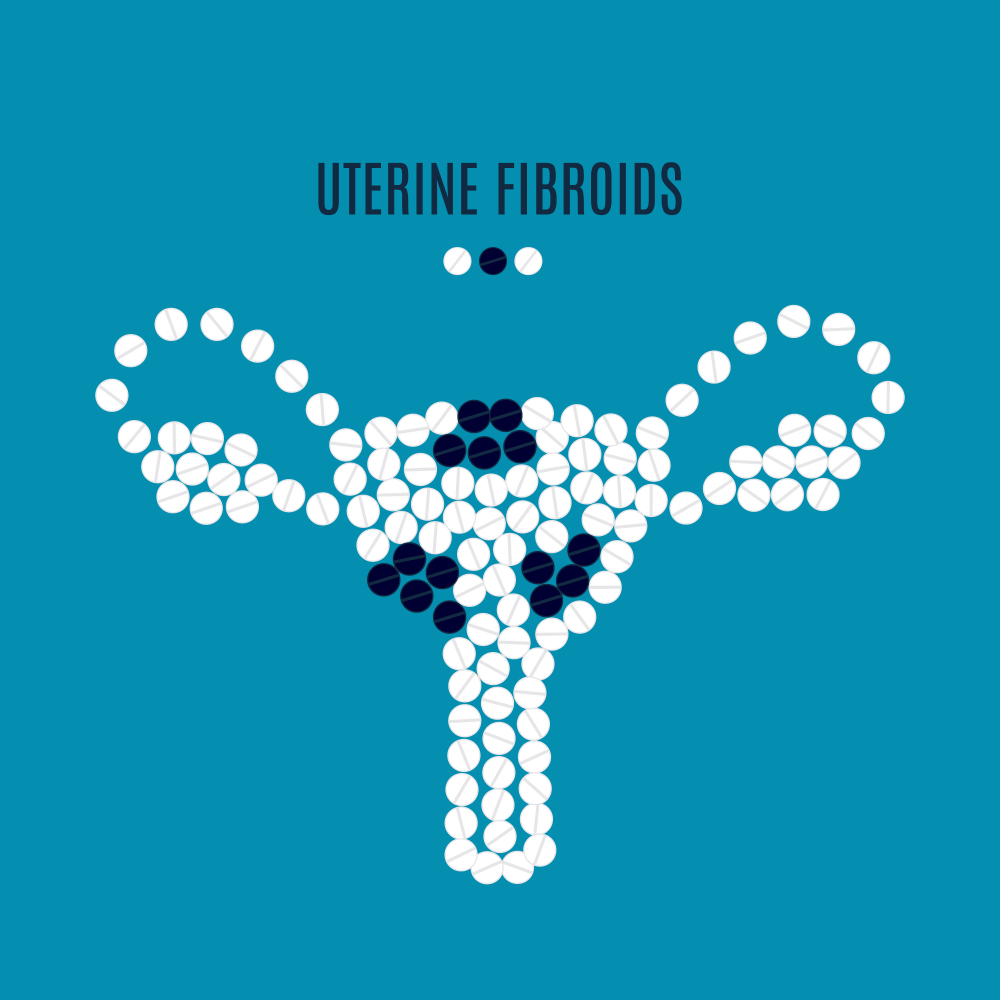What are uterine fibroids