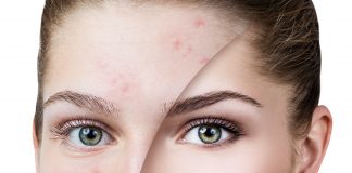 female-acne-update-continuing-education