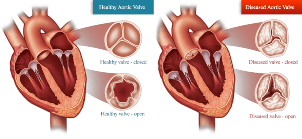 aortic valve and heart disease