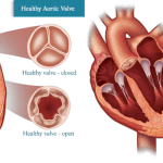 aortic valve and heart disease