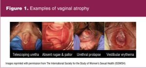 Figure 1 - Examples of vaginal atrophy