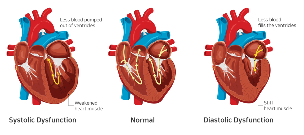 heart failure guide