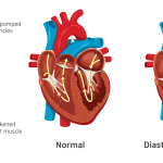 heart failure guide