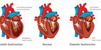 heart failure guide
