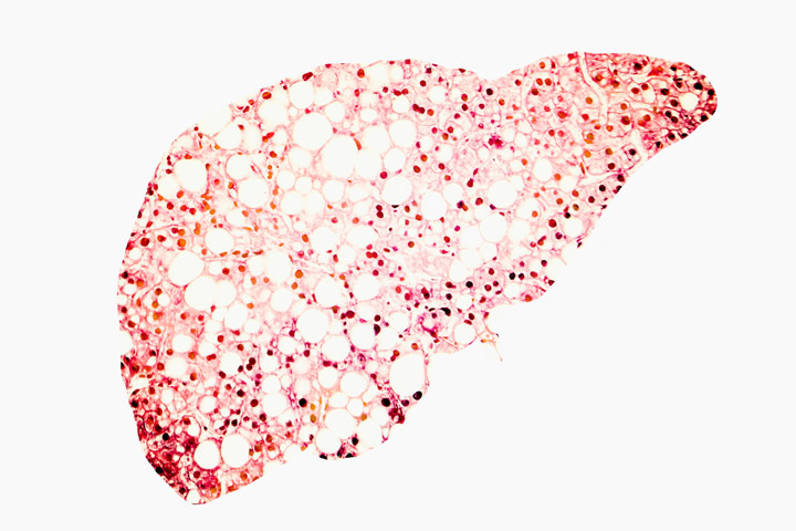 NAFLD