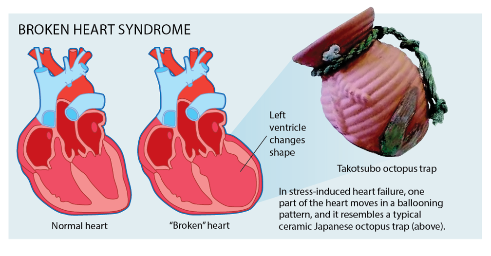 Takotsubo syndrome