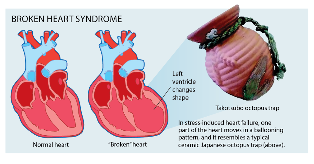 Takotsubo syndrome