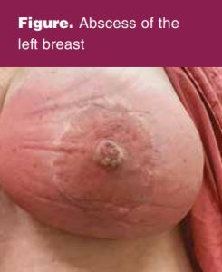 Abscess of the left breast