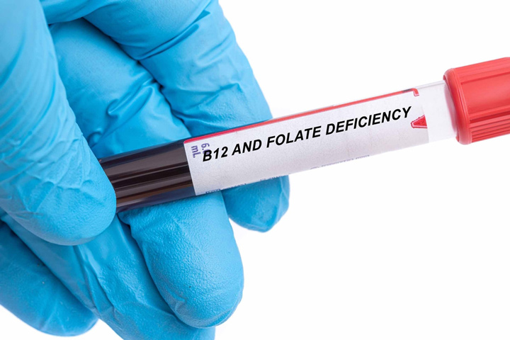 B12 deficiency