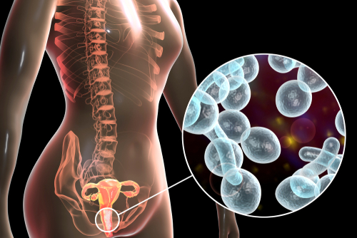 Recurrent yeast infections store