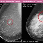 Mammography comparison of cancer easily seen in a a fatty (