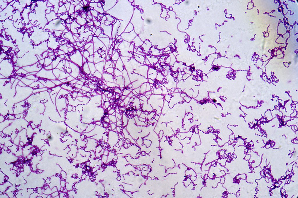 Pelvic actinomycosis