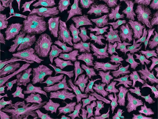 Cancer-causing viruses like HPV can cause cells to divide indefinitely and, in the case of Henrietta Lacks, become immortal. Tom Deerinck/NIH via Flickr, CC BY-NC